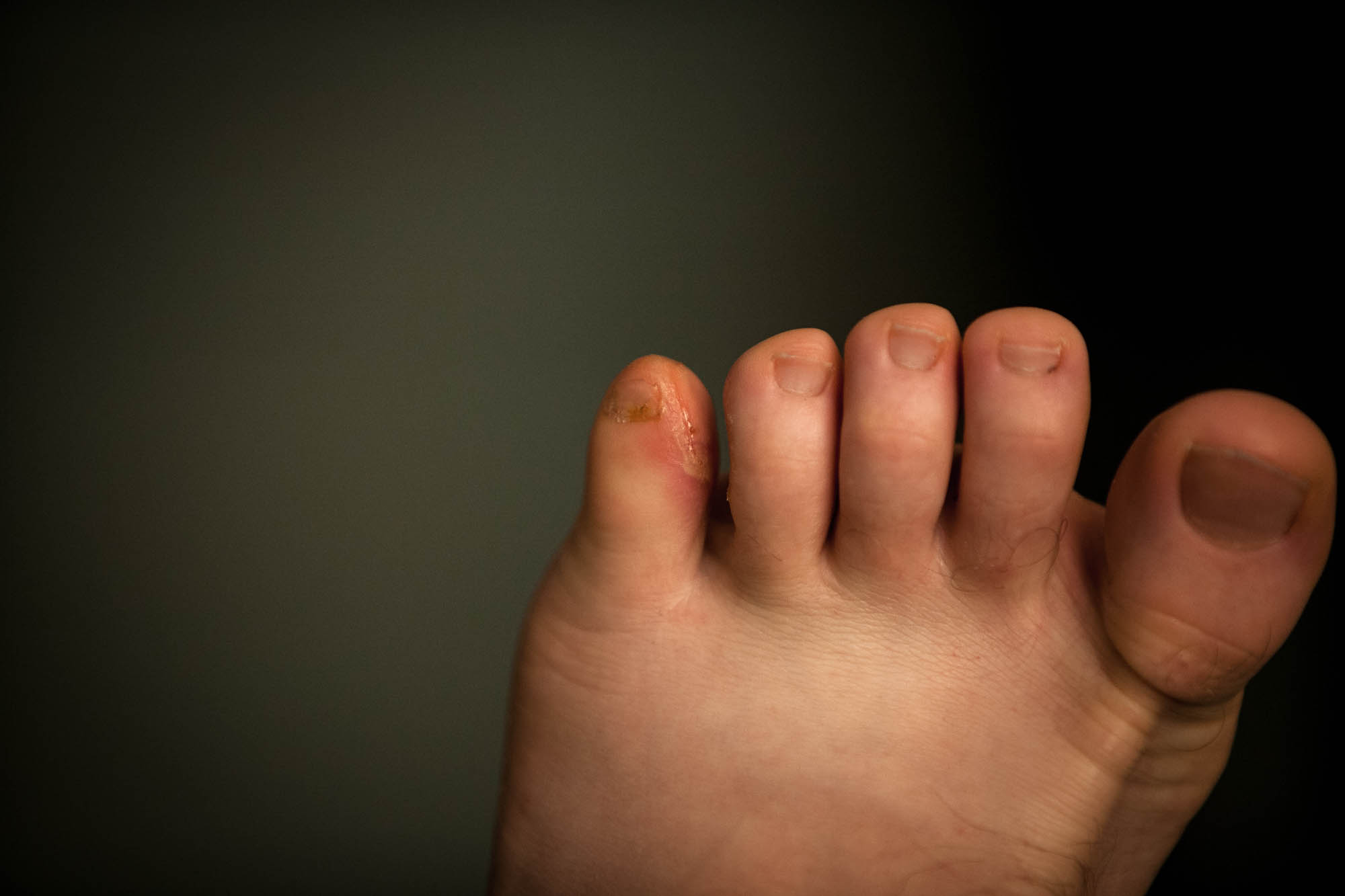 blistered left foot in Baoding
