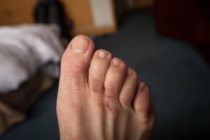 bad foot