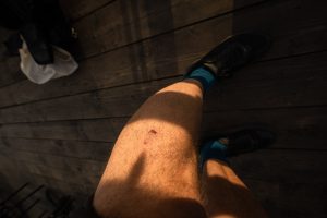 left leg after the dog attack