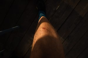 right leg after the dog attack